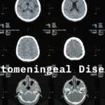 Leptomeningeal Disease